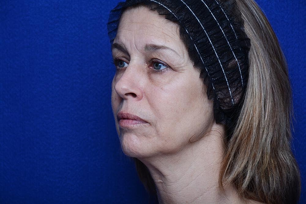 Liquid Facelift Before & After