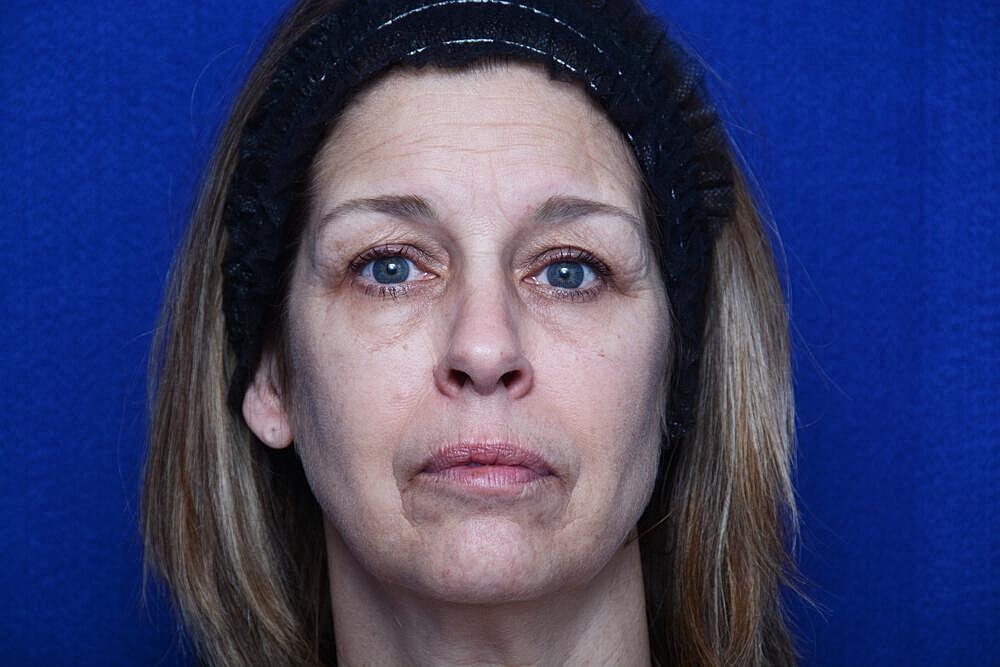 Liquid Facelift Before & After