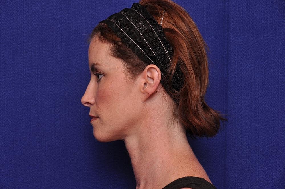 Liquid Facelift Before & After
