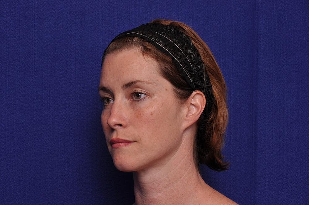 Liquid Facelift Before & After