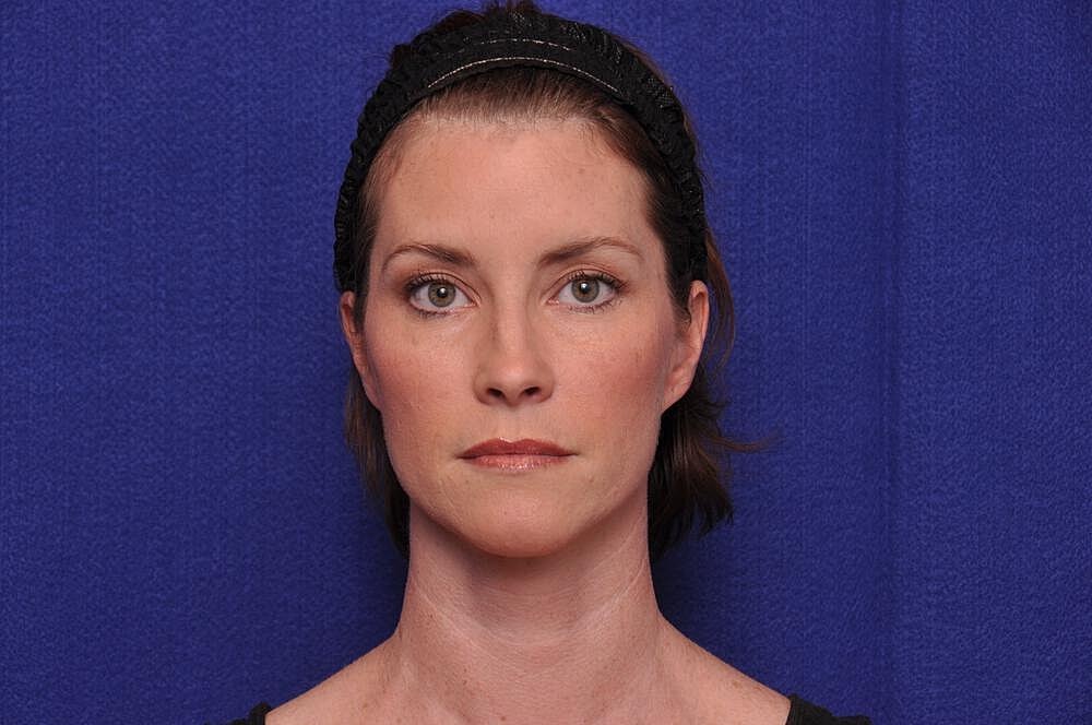 Liquid Facelift Before & After