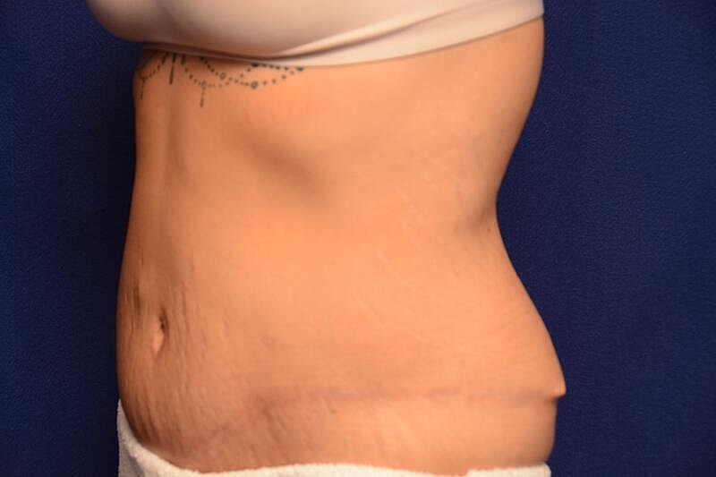 Body Lift Before & After