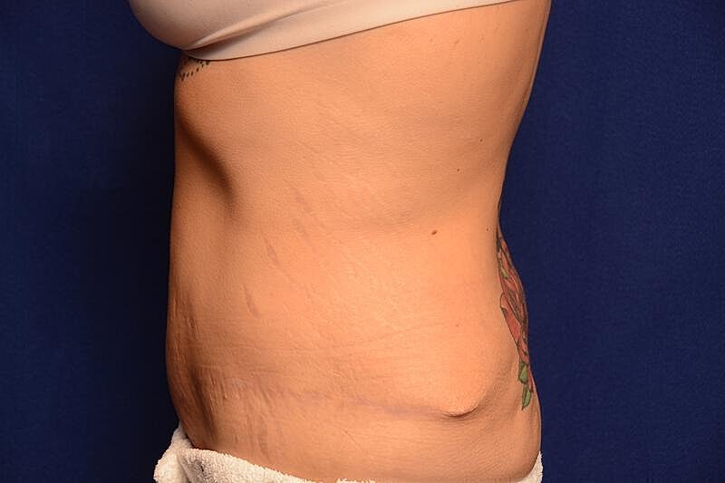Body Lift Before & After
