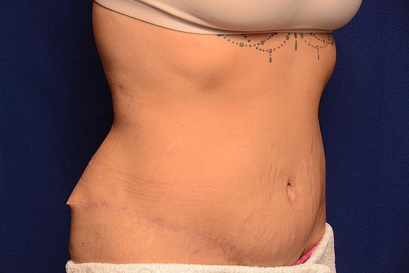 Body Lift Before & After
