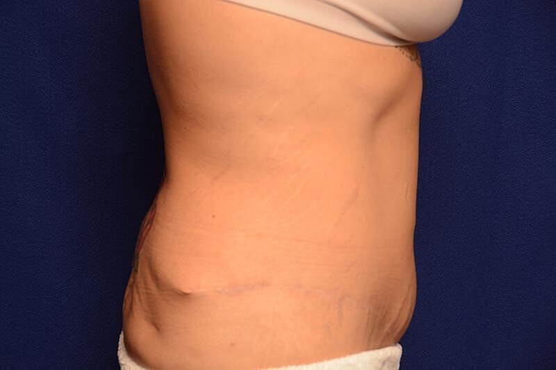 Body Lift Before & After