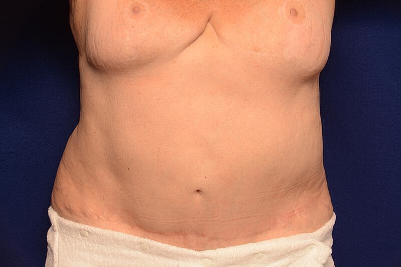 Body Lift Before & After