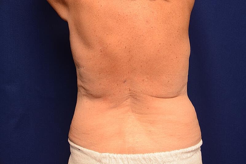 Body Lift Before & After