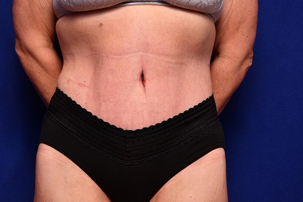 Body Lift Before & After
