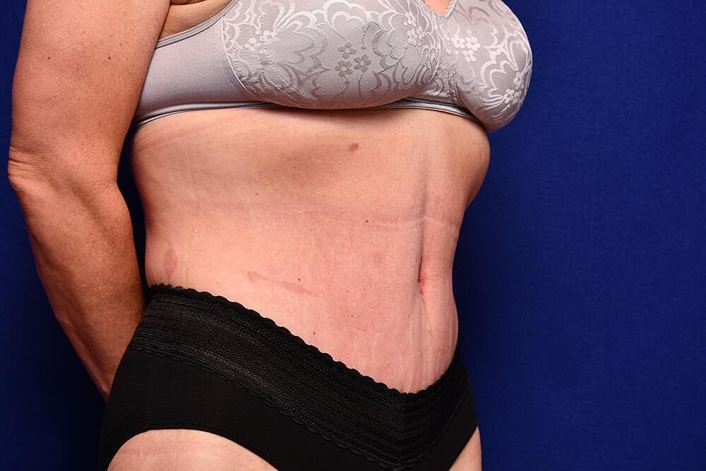 Body Lift Before & After