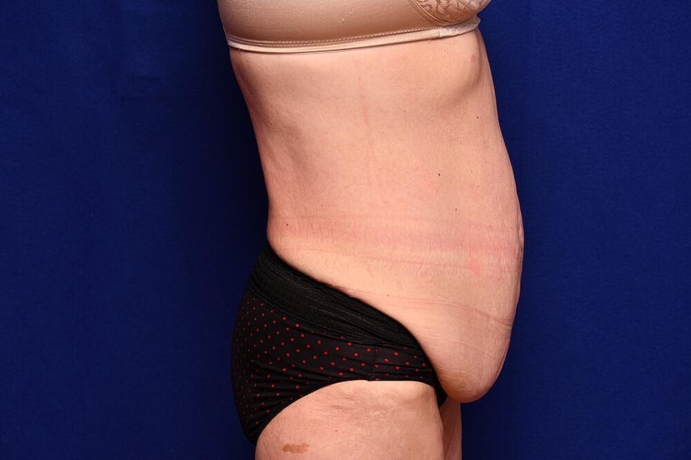 Body Lift Before & After