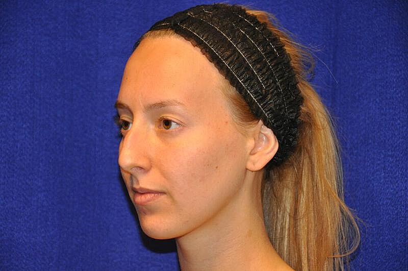 Rhinoplasty Before & After