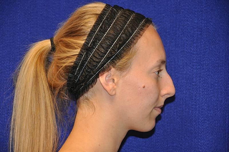 Rhinoplasty Before & After