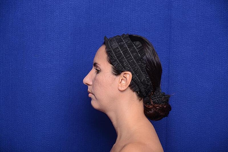Rhinoplasty Before & After
