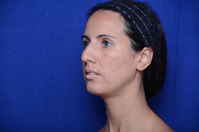 Rhinoplasty Before & After