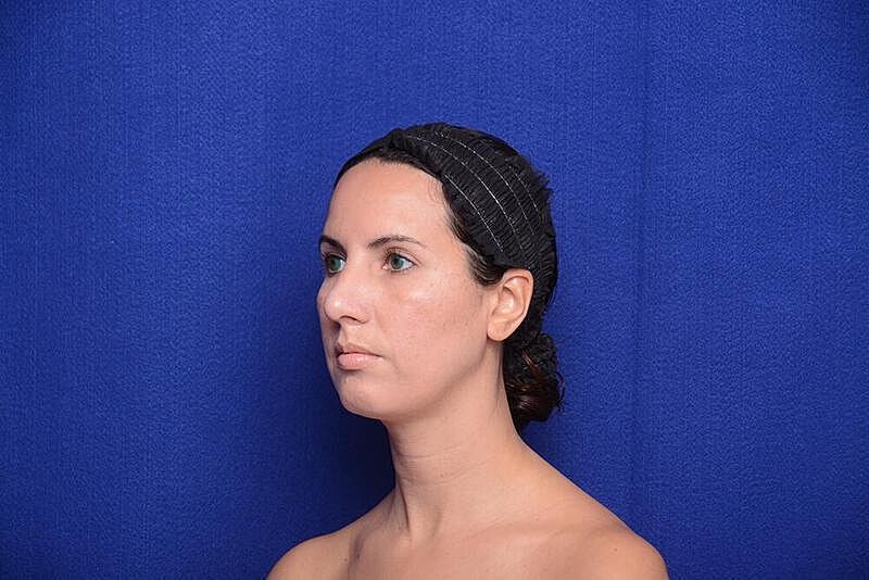 Rhinoplasty Before & After