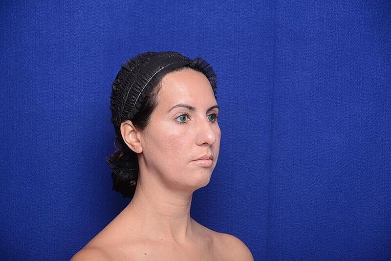 Rhinoplasty Before & After