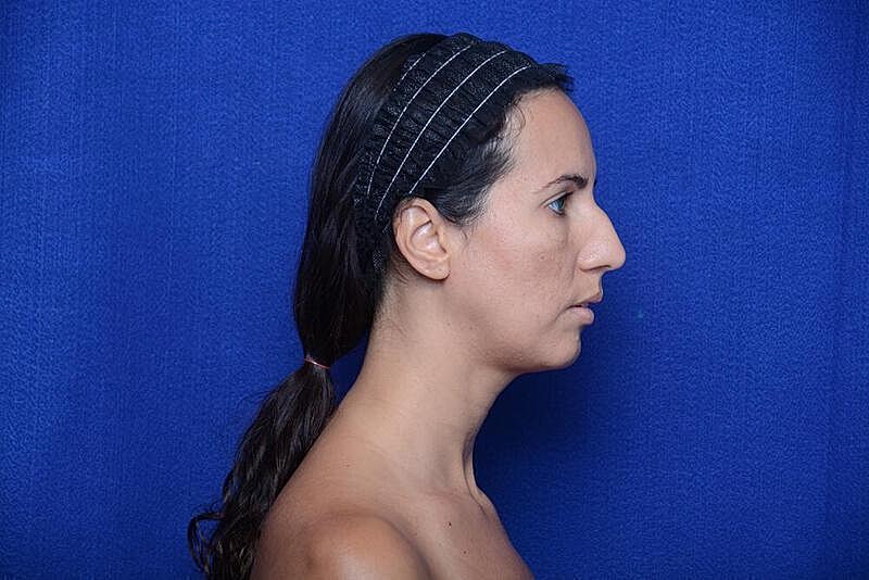 Rhinoplasty Before & After