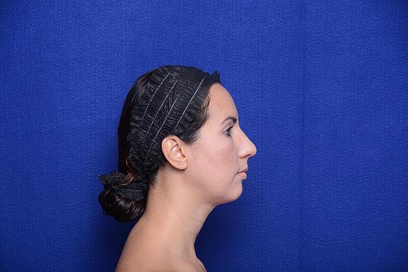 Rhinoplasty Before & After
