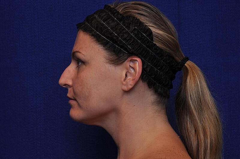 Rhinoplasty Before & After