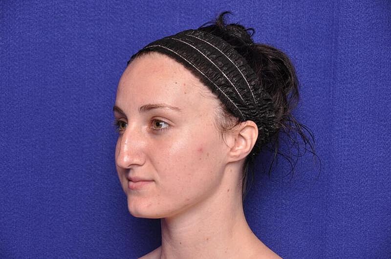 Rhinoplasty Before & After