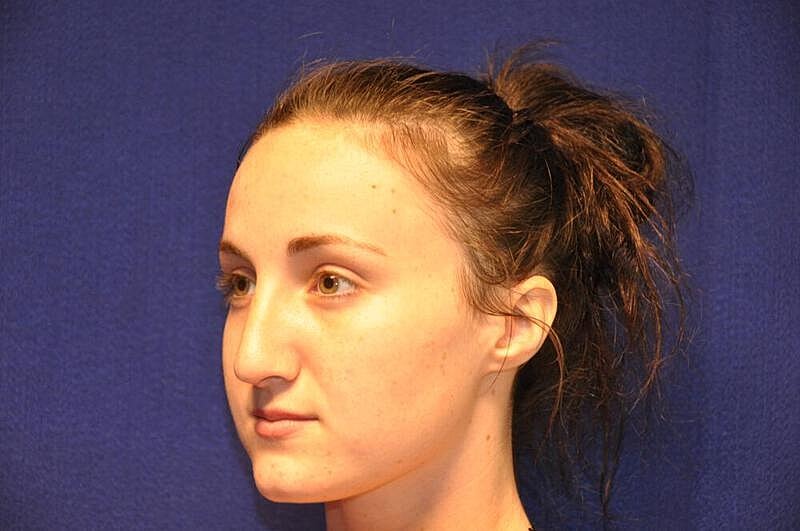 Rhinoplasty Before & After