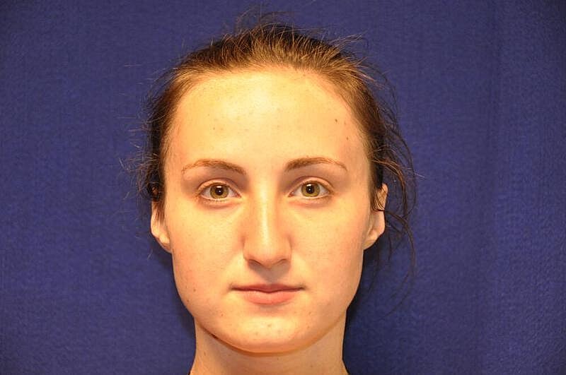 Rhinoplasty Before & After