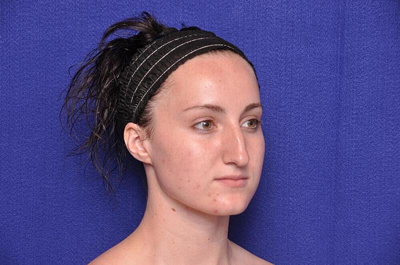 Rhinoplasty Before & After