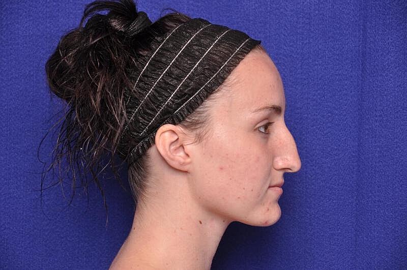 Rhinoplasty Before & After