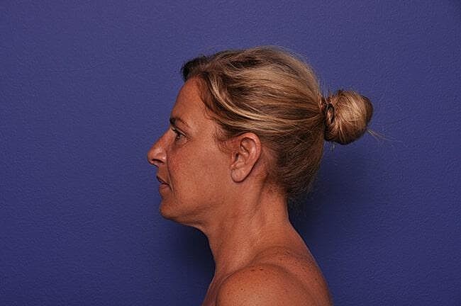Rhinoplasty Before & After