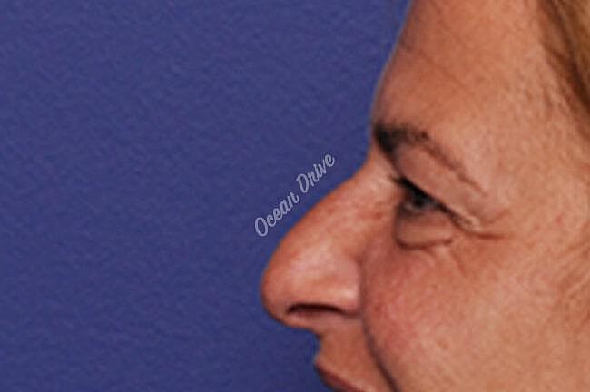Rhinoplasty Before & After