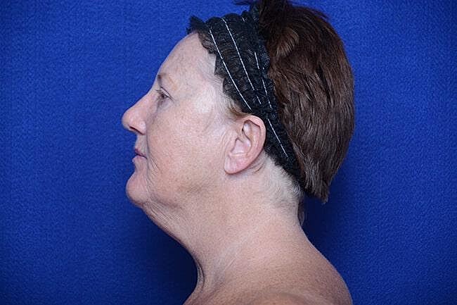 Rhinoplasty Before & After