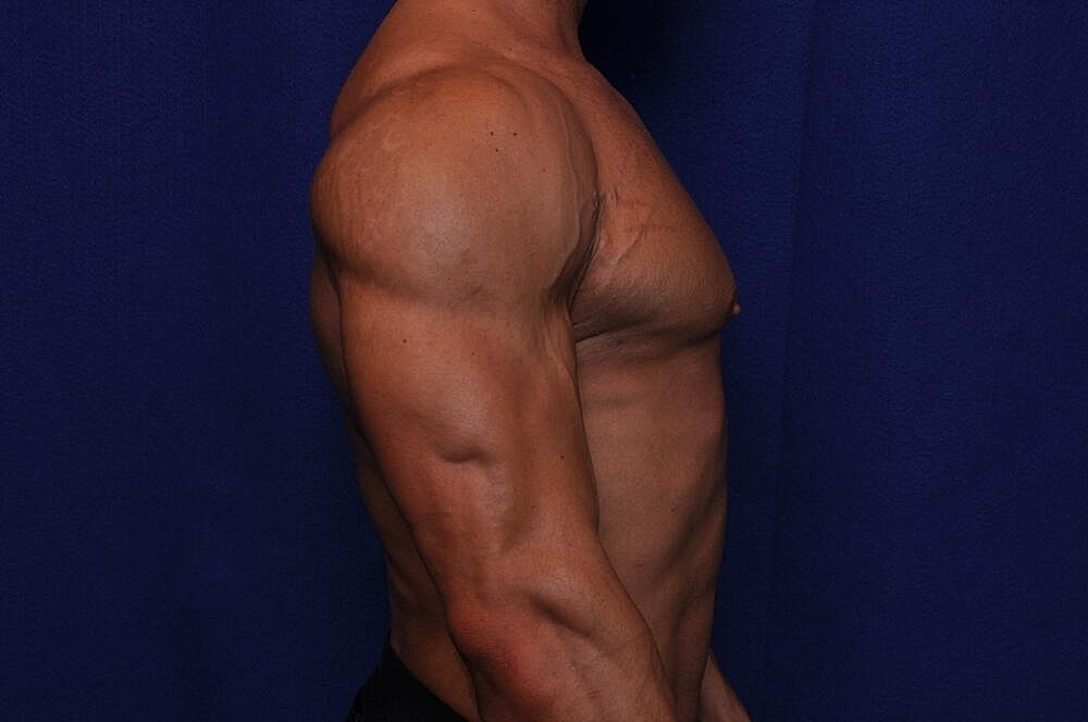 Athletic Gynecomastia Surgery Before & After
