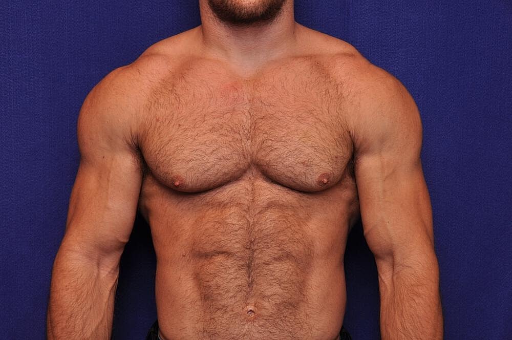 Athletic Gynecomastia Surgery Before & After