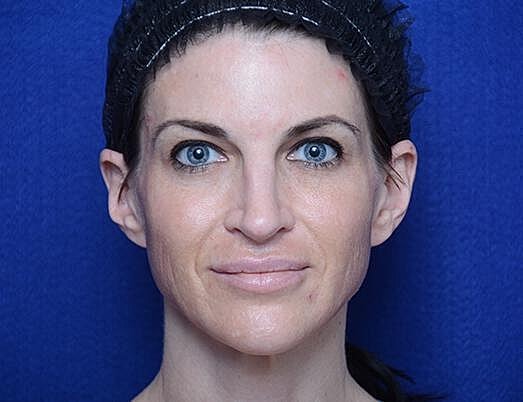 Chemical Brow Lift Before & After