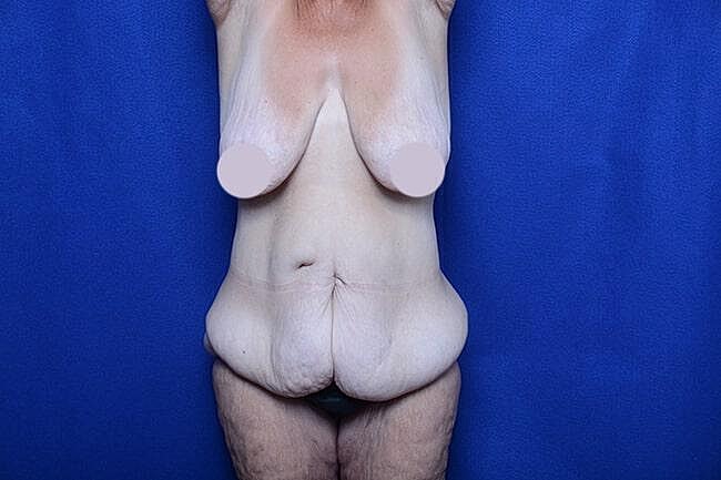 After Massive Weight Loss Surgery Before & After