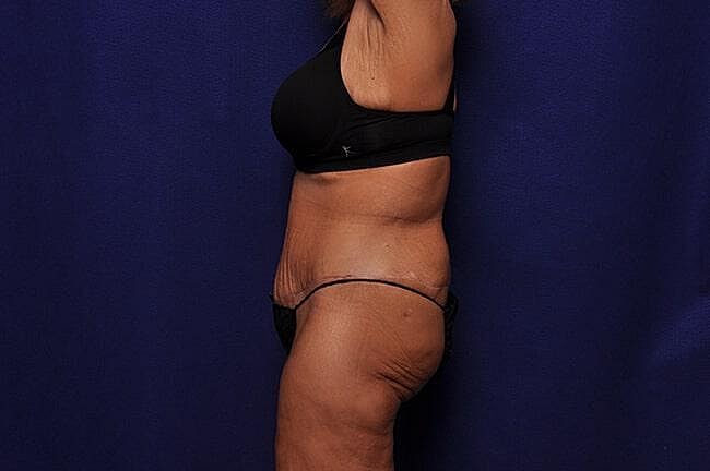 After Massive Weight Loss Surgery Before & After