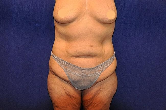 After Massive Weight Loss Surgery Before & After
