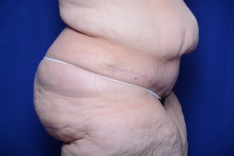 After Massive Weight Loss Surgery Before & After