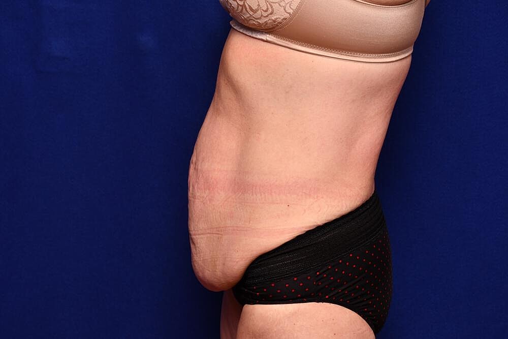 After Massive Weight Loss Surgery Before & After