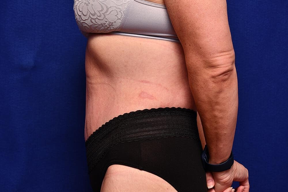 After Massive Weight Loss Surgery Before & After