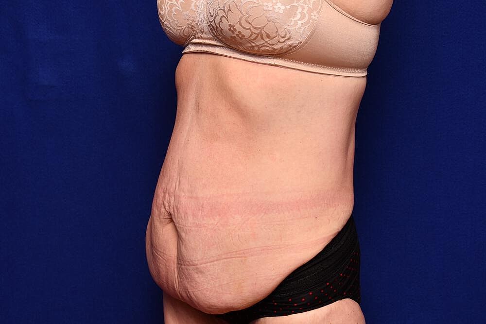 After Massive Weight Loss Surgery Before & After