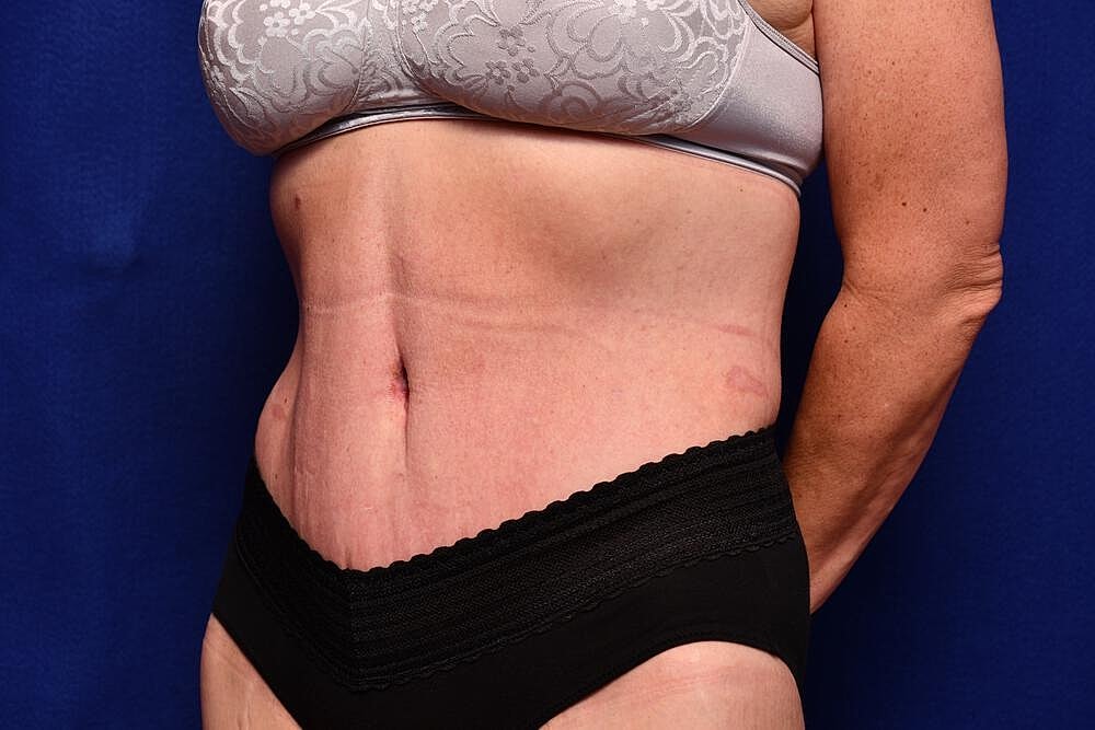 After Massive Weight Loss Surgery Before & After