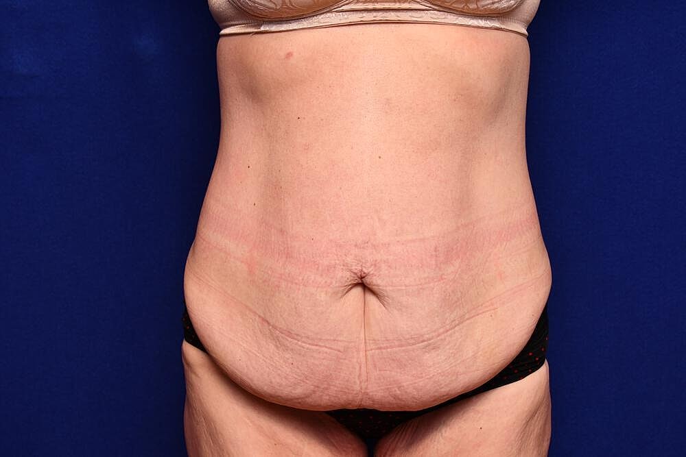 After Massive Weight Loss Surgery Before & After
