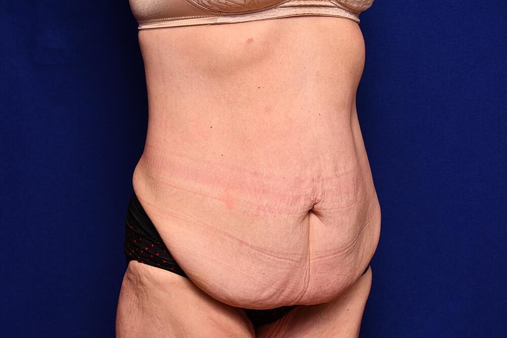 After Massive Weight Loss Surgery Before & After