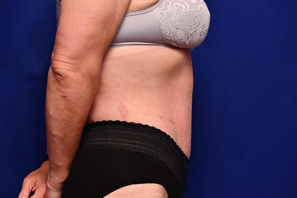 After Massive Weight Loss Surgery Before & After