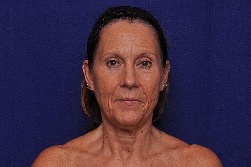 Fractional Laser Before & After