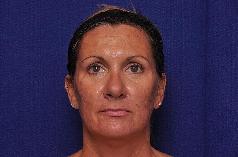Fractional Laser Before & After