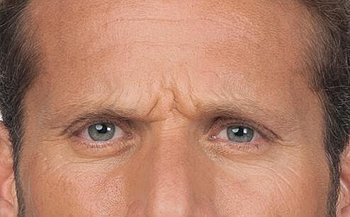 Botox Men Before & After