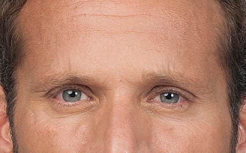 Botox Men Before & After