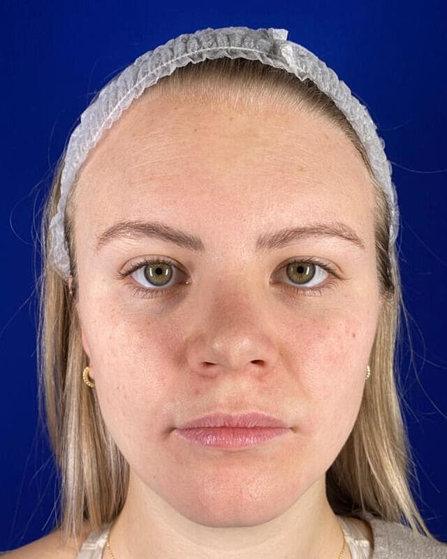 Injectables Before & After